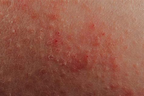20 Types of Skin Lesions: Causes and Pictures
