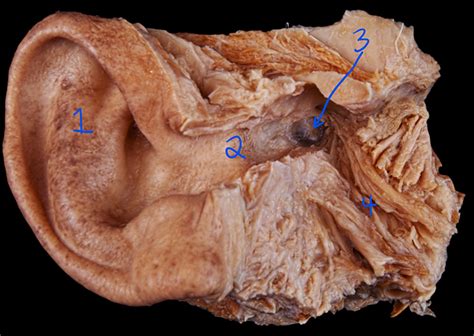 Solved Part A The external acoustic (auditory) meatus is | Chegg.com 