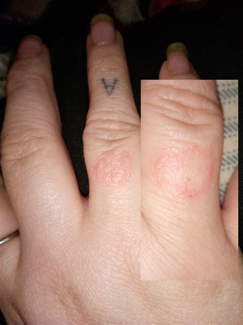 Ringworm, wedding ring rash, or something else? Main pic Jan 4. Pic on