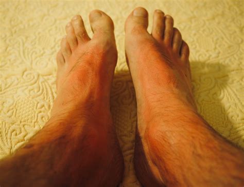 sunburn home remedies 3