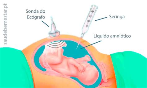 O Que É Amniocentese