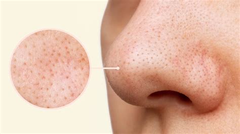 Blackheads On Forehead Removal