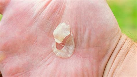 penyebab kulit tangan mengelupas   mengatasinya klikdokter