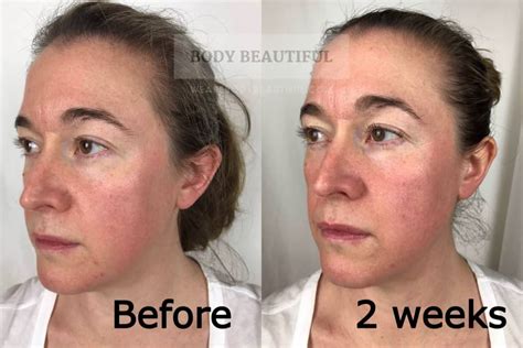 tria beauty age defying eye wrinkle correcting laser sale codes www