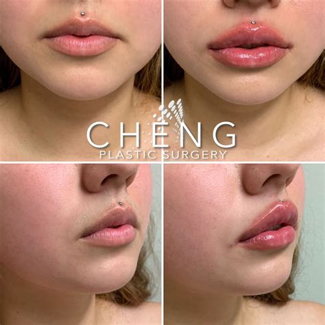 how to care for lips after filler