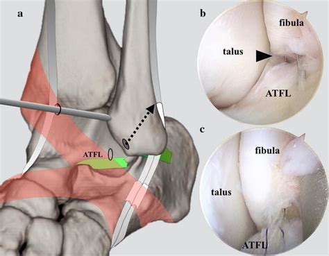 The location and direction of the first suture anchor (a, b) and the ...