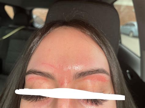 Help, my skin ripped off after getting my eyebrows waxed. I know my