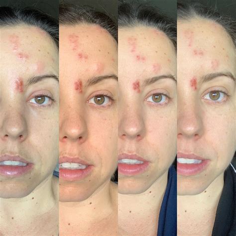 early stage mild sun poisoning on face 2