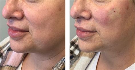 complete guide  face thread lifts