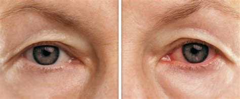 Normal Eyes Vs Cataract Surgery Connecticut | Cataracts Middletown