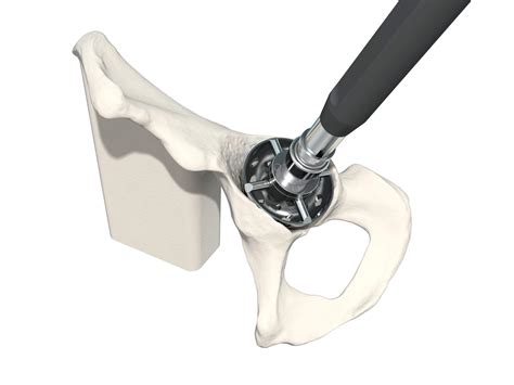 Joint Reconstruction - SYNBONE