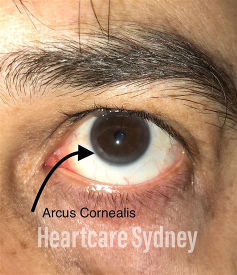 arcus cornealis