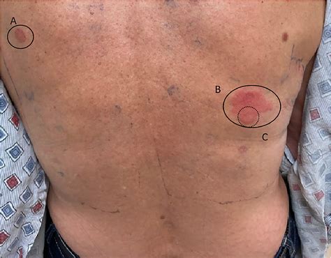Methylisothiazolinone-containing paint contributing to mucocutaneous