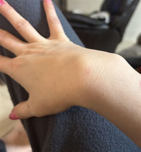 What’s this lump on my wrist? : r/AskDoctorSmeeee