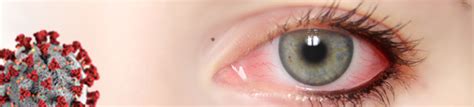 Olhos Vermelhos Gripe Ou Covid - Implicações oculares da Covid19