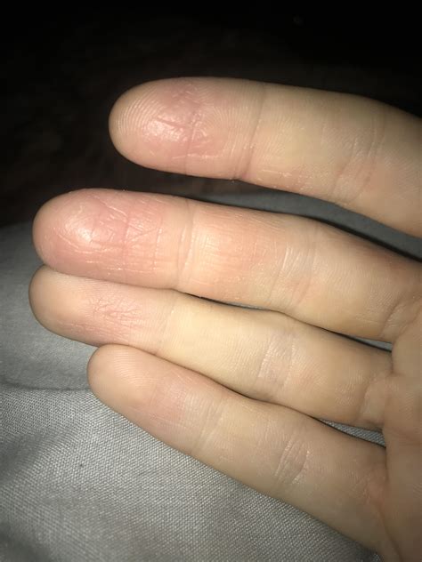 Continuous use of cortisone (ik it’s not healthy but I’m desperate) has