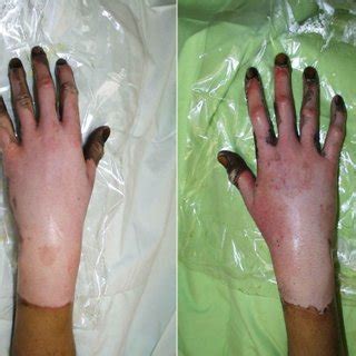 Superficial partial-thickness facial burns caused by the rapid passage ...
