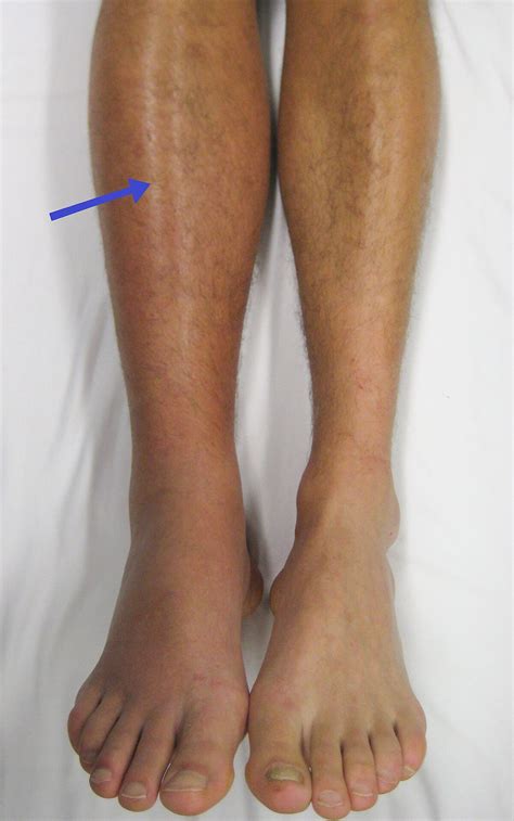 venous thrombosis - Wikidata