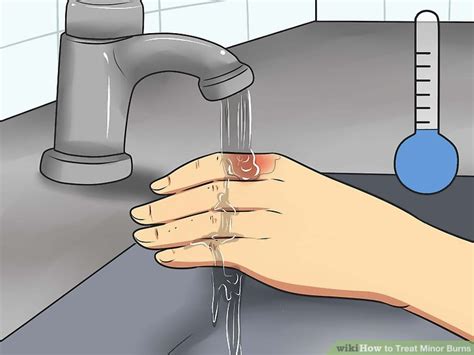 how to treat severe burns at home