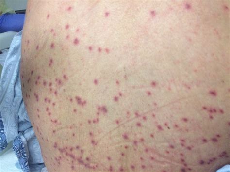 disseminated herpes zoster disseminated zoster  england journal