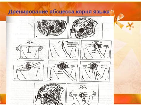 Презентация Абсцесс флегмона языка