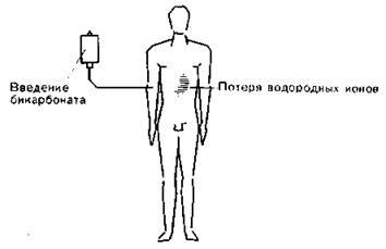 Метаболический алкалоз