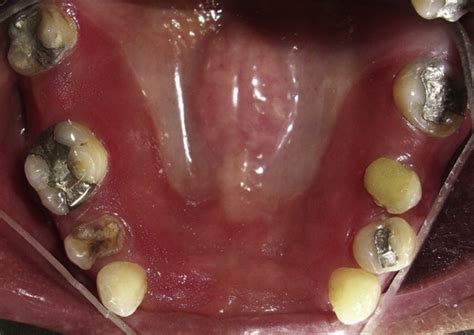 oral fungal infections dental clinics