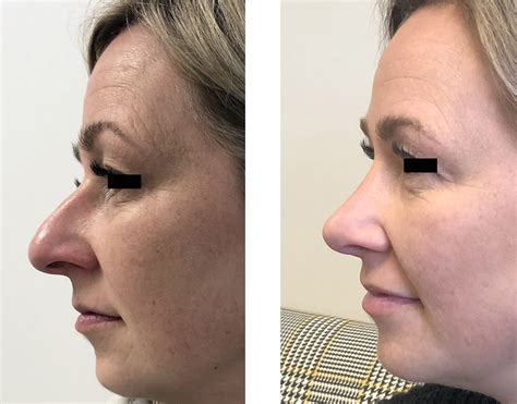 Plastic surgery before & after photos | Rhinoplasty Surgery