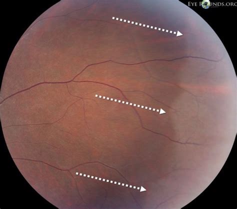 Abnormal ocular conditions- L13 and L14 part 3 Benign Peripheral ...