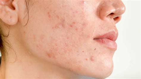 Acne Scars-Causes, Types, Treatments and Prevention Tips - Dr. Praneeth