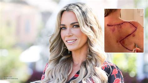 Teddi Cancer Awareness RHOBHTeddi Mellencamp Spreads Melanoma Awareness ...