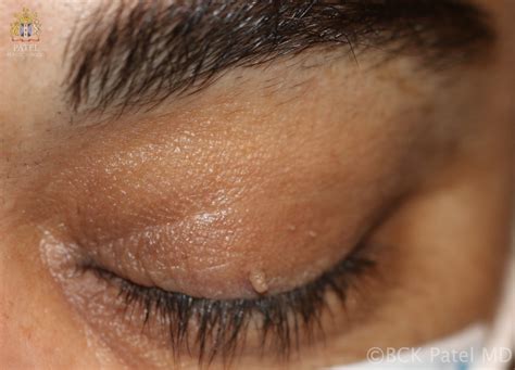 Eyelid Skin Tags: Causes And Treatment All About Vision, 51% OFF