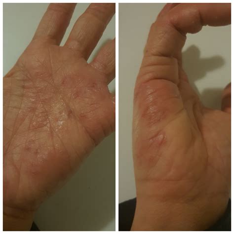 Dyshidrotic Eczema Crohn's Disease at Nicole Webber blog