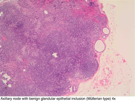 Pathology Outlines - Axillary lymph nodes
