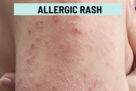 Itchy Bumps on Skin: 21 Causes, Pictures, and Treatment