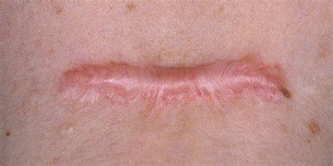 Effective Methods to Smooth Out Leg Scars: Top Techniques for Clearer Skin - Hunter Games Magazine