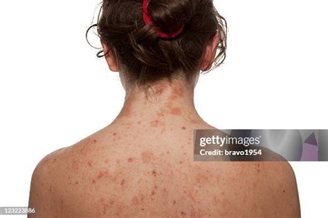 dermatitis stock  high res pictures  images getty images