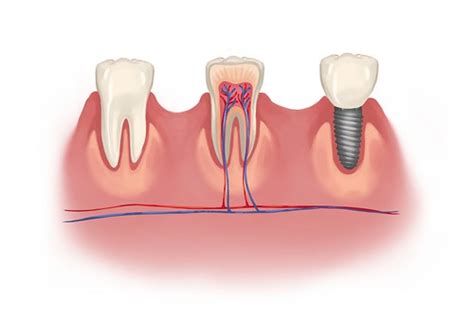dental implant  natural tooth  nerves technical pic flickr