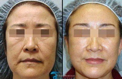 surgical stem cell facelift enriched msc cells cal face
