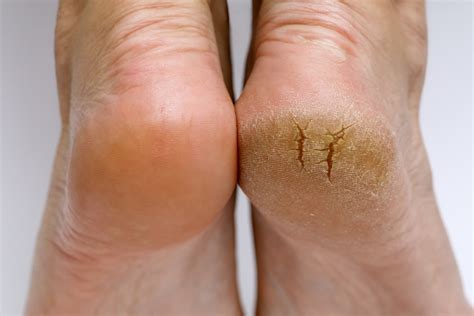 treat diabetes swollen feet lifemd