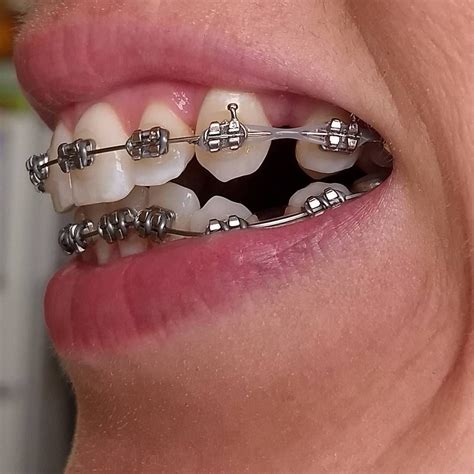 gray braces chain  anthony dorsett blog