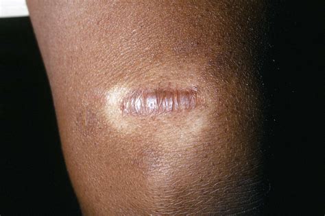 laser treatment  scars