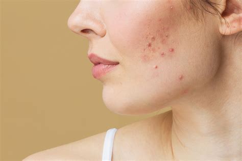 treat hormonal acne dallas dermatology partners