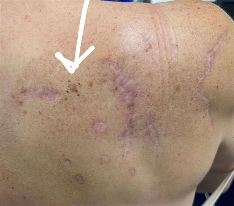 Teddi Mellencamp Reveals She’s Having Surgery to Remove Another Melanoma