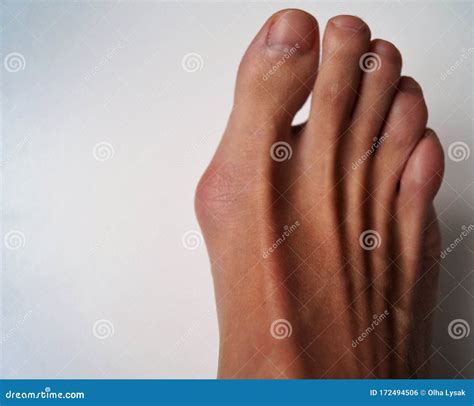 A Bump on the Big Toe of the Man Physiological Health Problem Stock ...