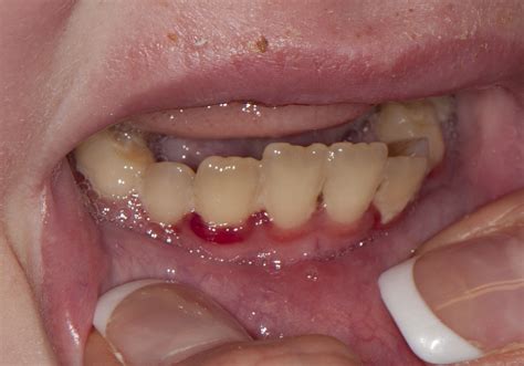 Vitamin C deficiency (Scurvy) - Cancer Therapy Advisor