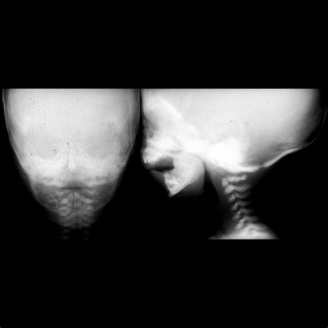 Pierre Robin Syndrome | Pediatric Radiology Reference Article