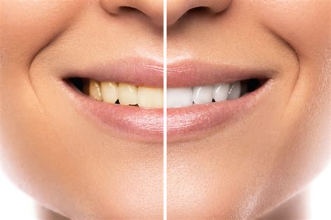 10 Benefits of Professional Teeth Whitening Near Me - Wellington Dentistry