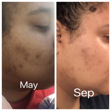 [b&a][selfie] 4 month PIH progress : r/SkincareAddiction
