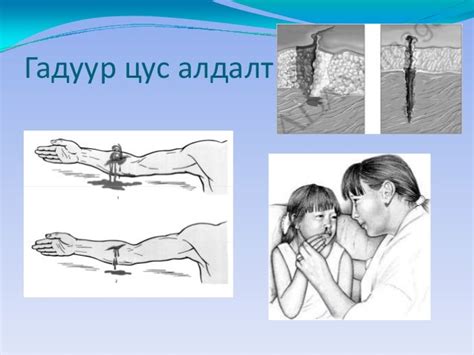 цус алдалтын үед авах арга хэмжээ